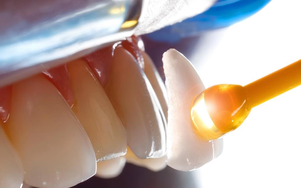 Veneer Porselen Kaplama İstanbul | Diş Tabibi